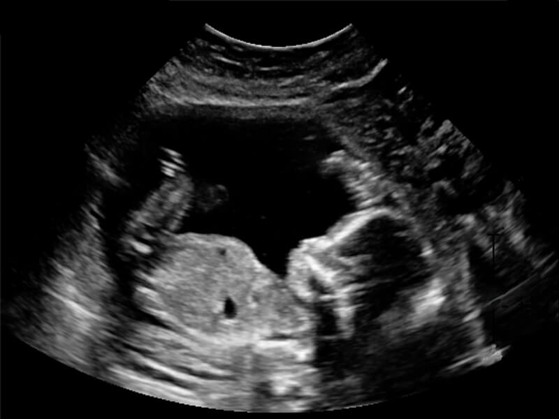 Ultrasound photo of Baby Jones